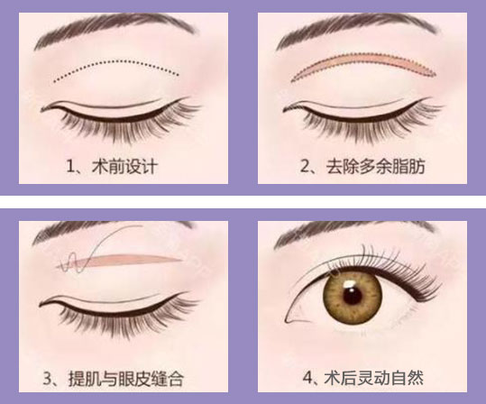 切开双眼皮