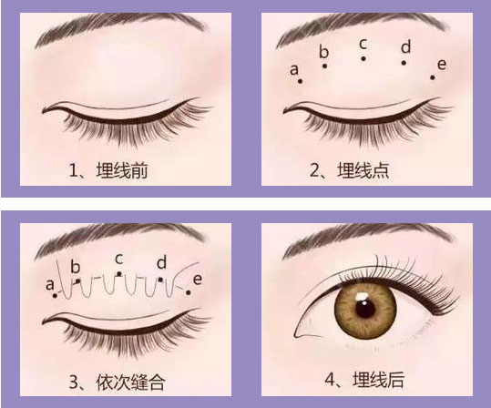埋线双眼皮