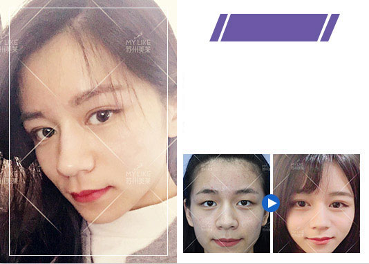 美莱双眼皮案例