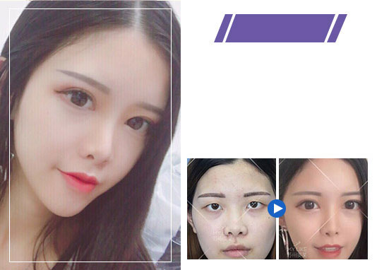 美莱双眼皮案例