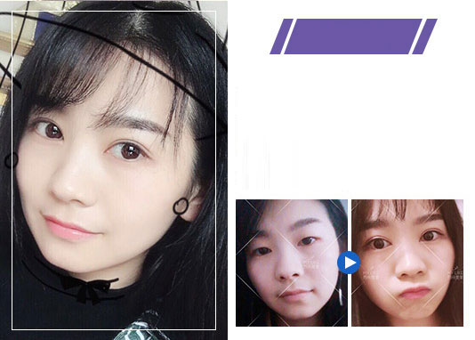 美莱双眼皮案例