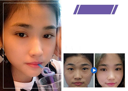 美莱双眼皮案例